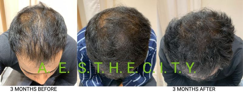 Hair regrowth 3 months before and after