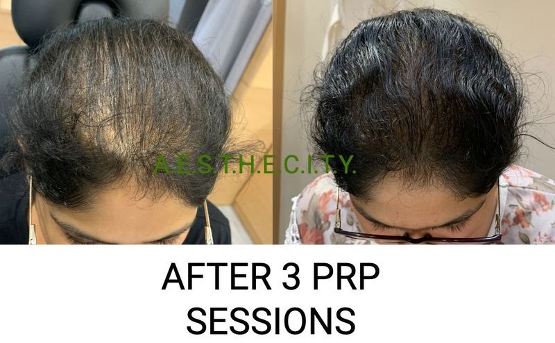 PRP hair treatment after 3 sessions