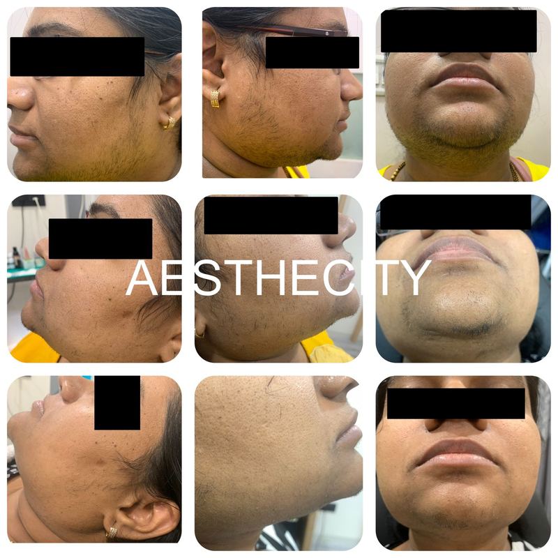 Laser hair reduction results