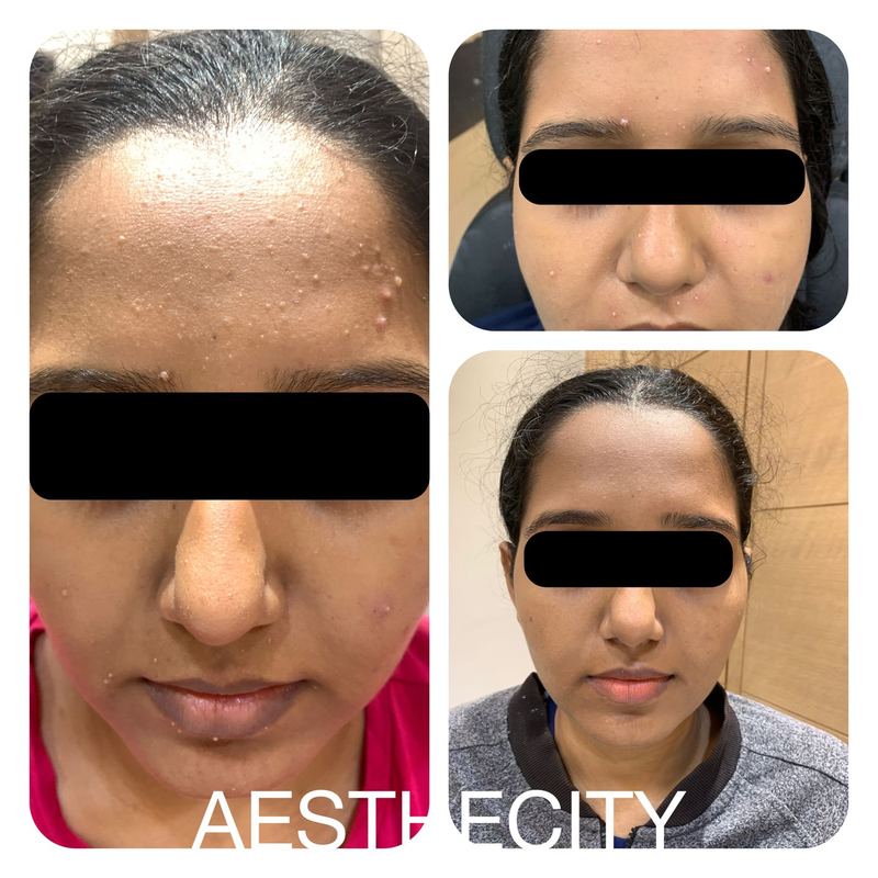 Skin clearing treatment results