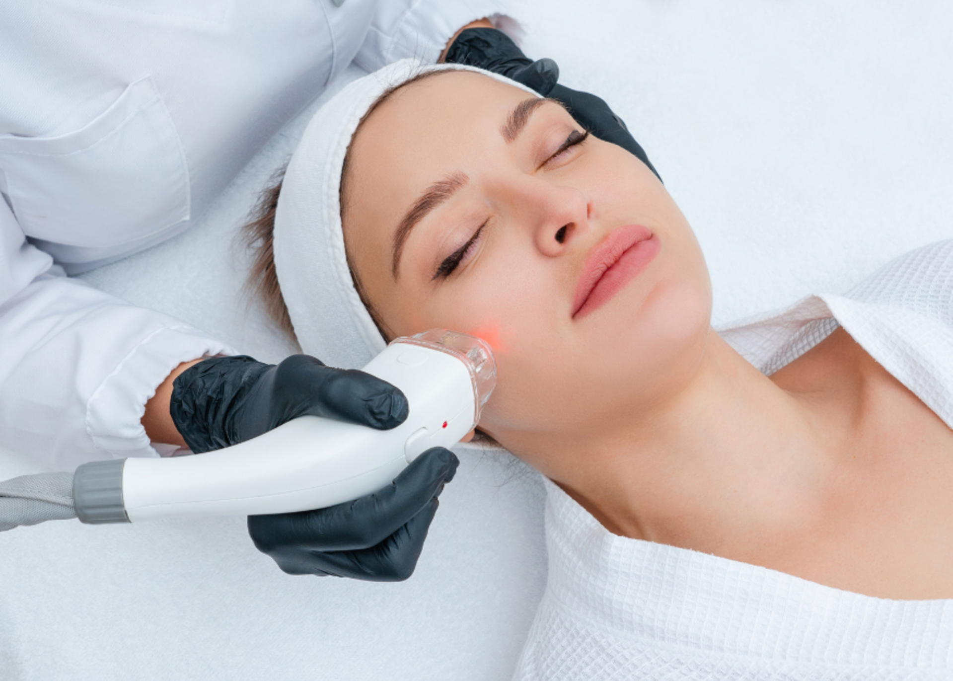 Laser Acne Treatment