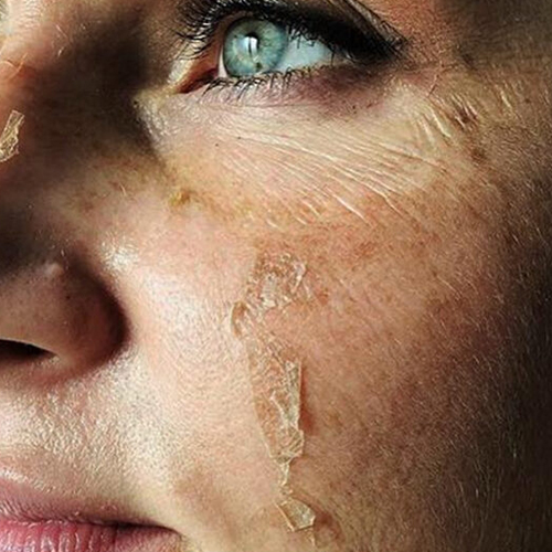 Chemical peeling treatment in PCMC by Dr. Shrikant Khanapurkar