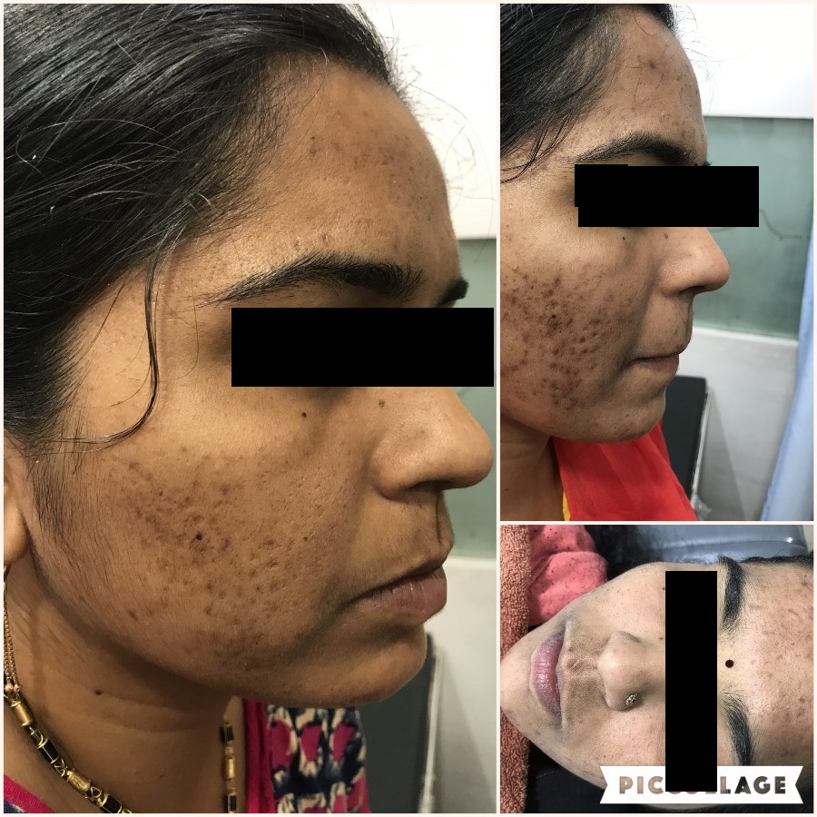 ACNE G1 (2)