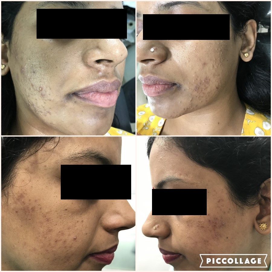 ACNE G1