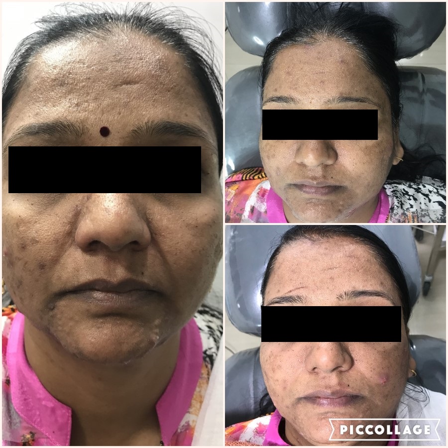 ACNE G2