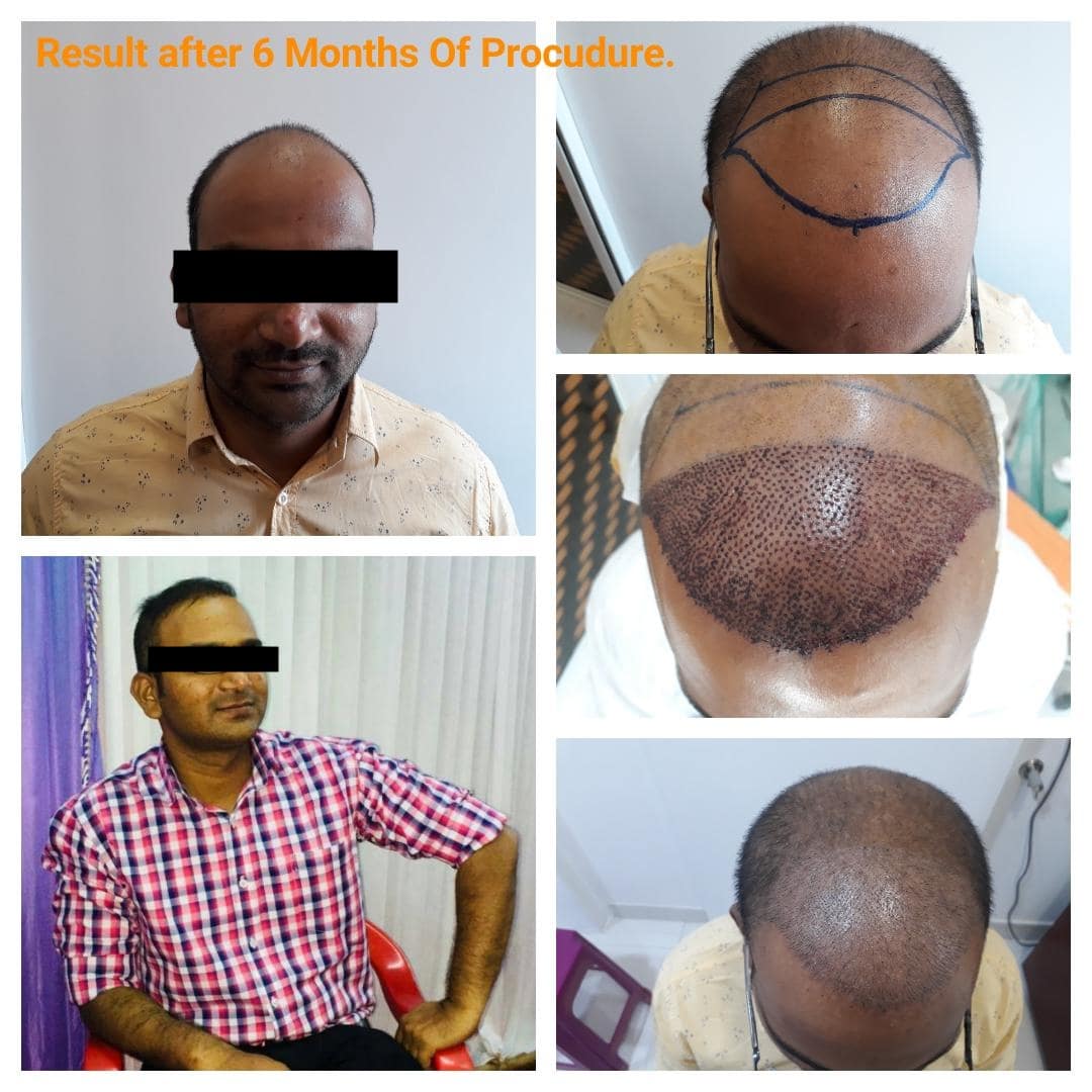 Hair Transplant1