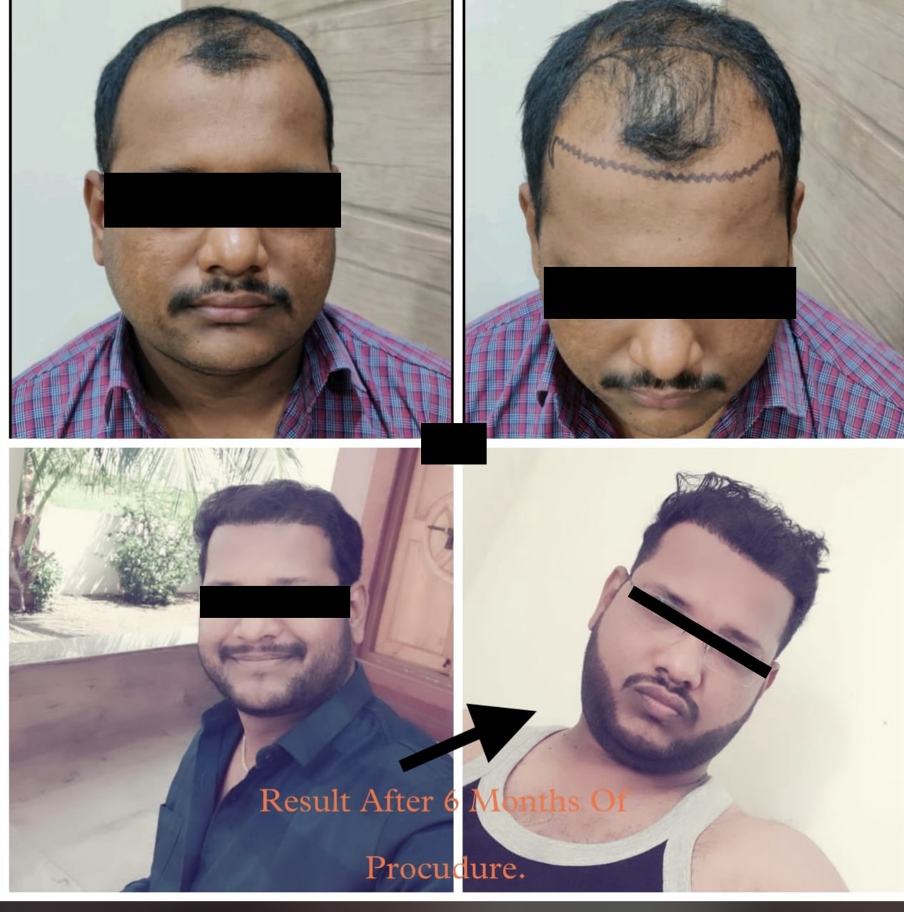 Hair Transplant2