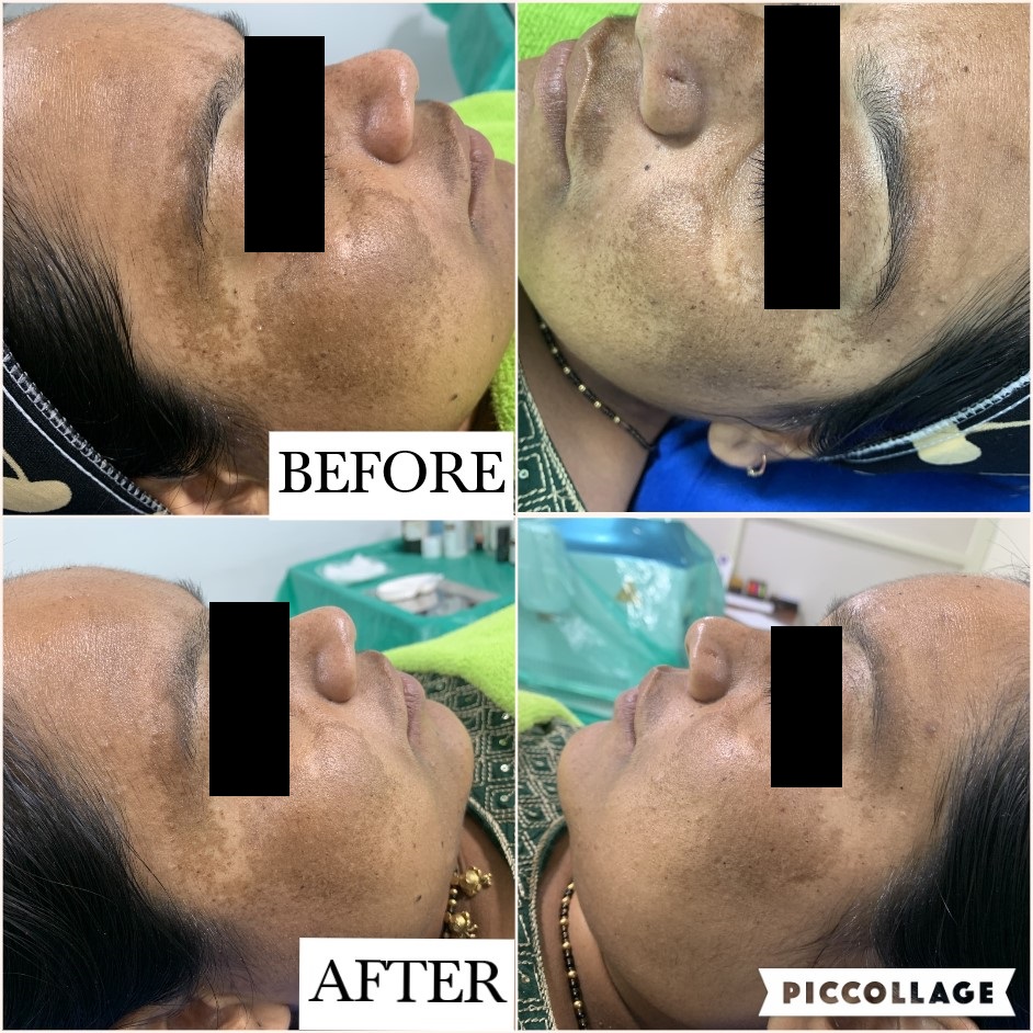 MELASMA G4 (2)