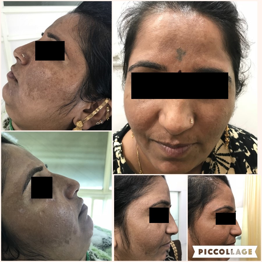 MELASMA G4