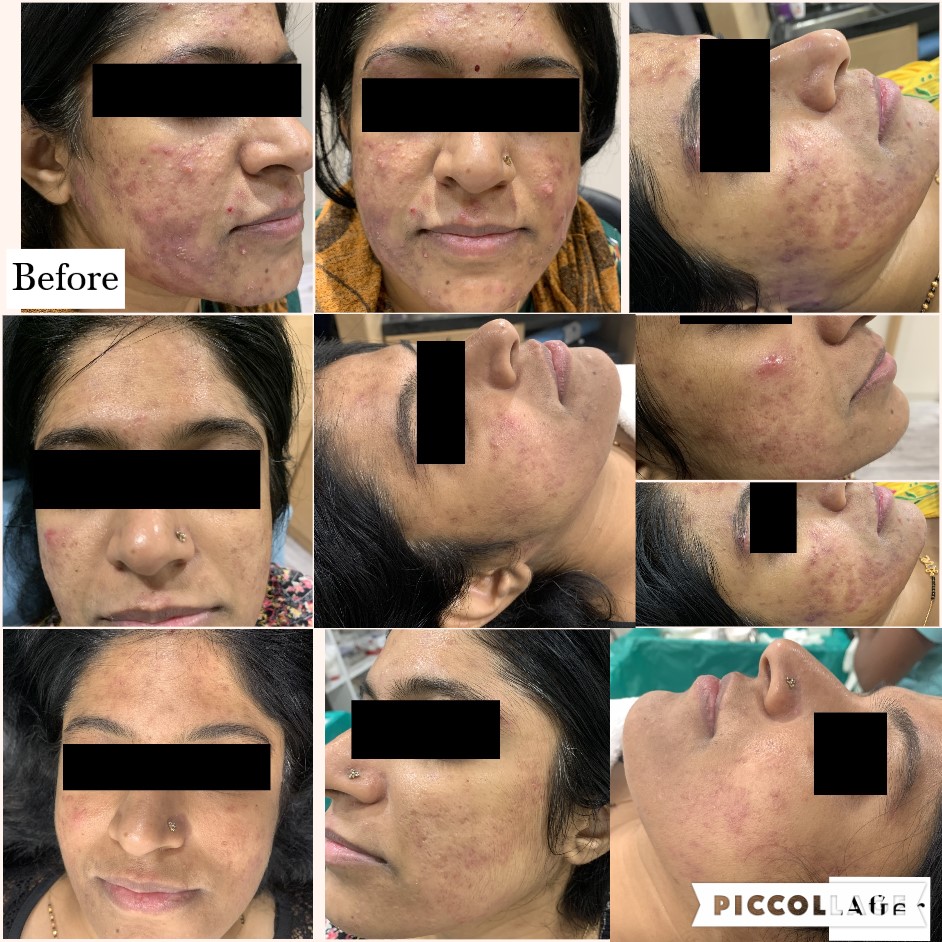 acne -g4